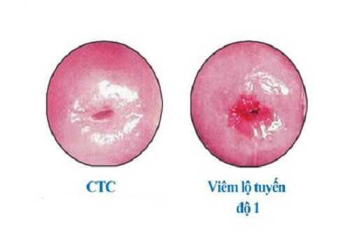 Viêm lộ tuyến cổ tử cung cấp độ 1 